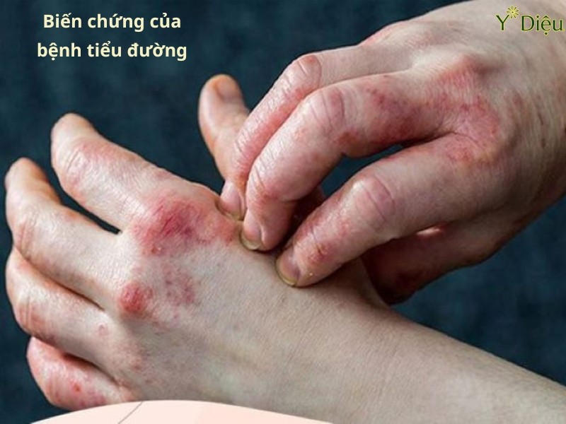 Hậu quả của bệnh tiểu đường gây ra cảm giác đau và nhiệt ở bàn tay.